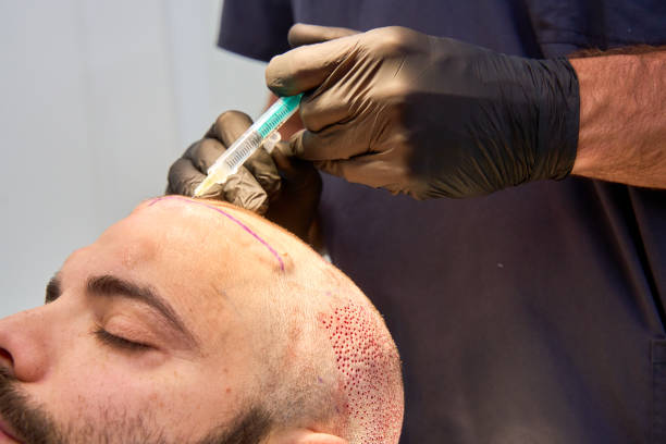 ما الذي يجعل زراعة الشعر في دبي تبدو طبيعية تمامًا؟